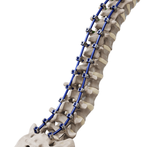 Full Spine and Screw Cage